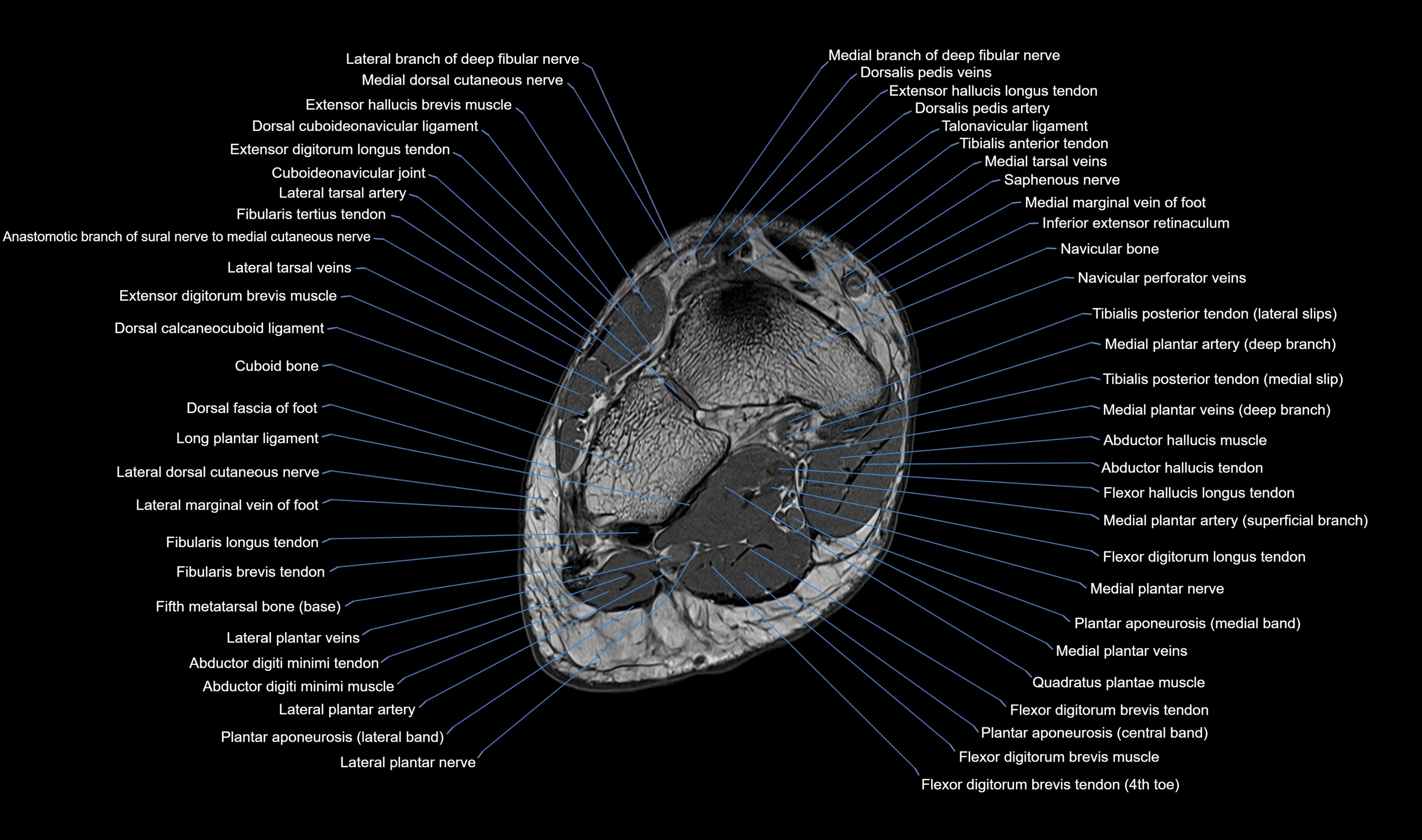 MRI mid foot axial cross sectional anatomy 3T  radiology  image-img-00001-00030.webp